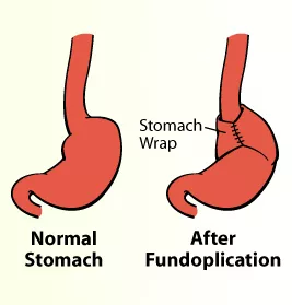 Fundoplication