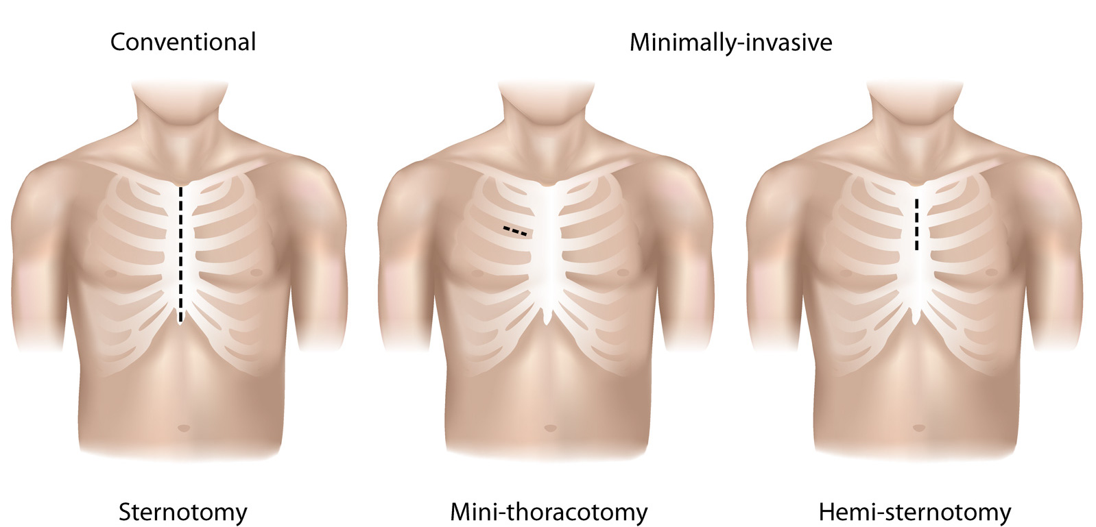 Skin Incision Final