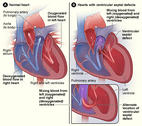 ventr_septal_defect