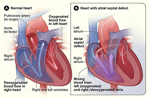 atrial_septal_defect