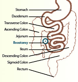 ileostomy