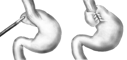 Nissen Fundoplication